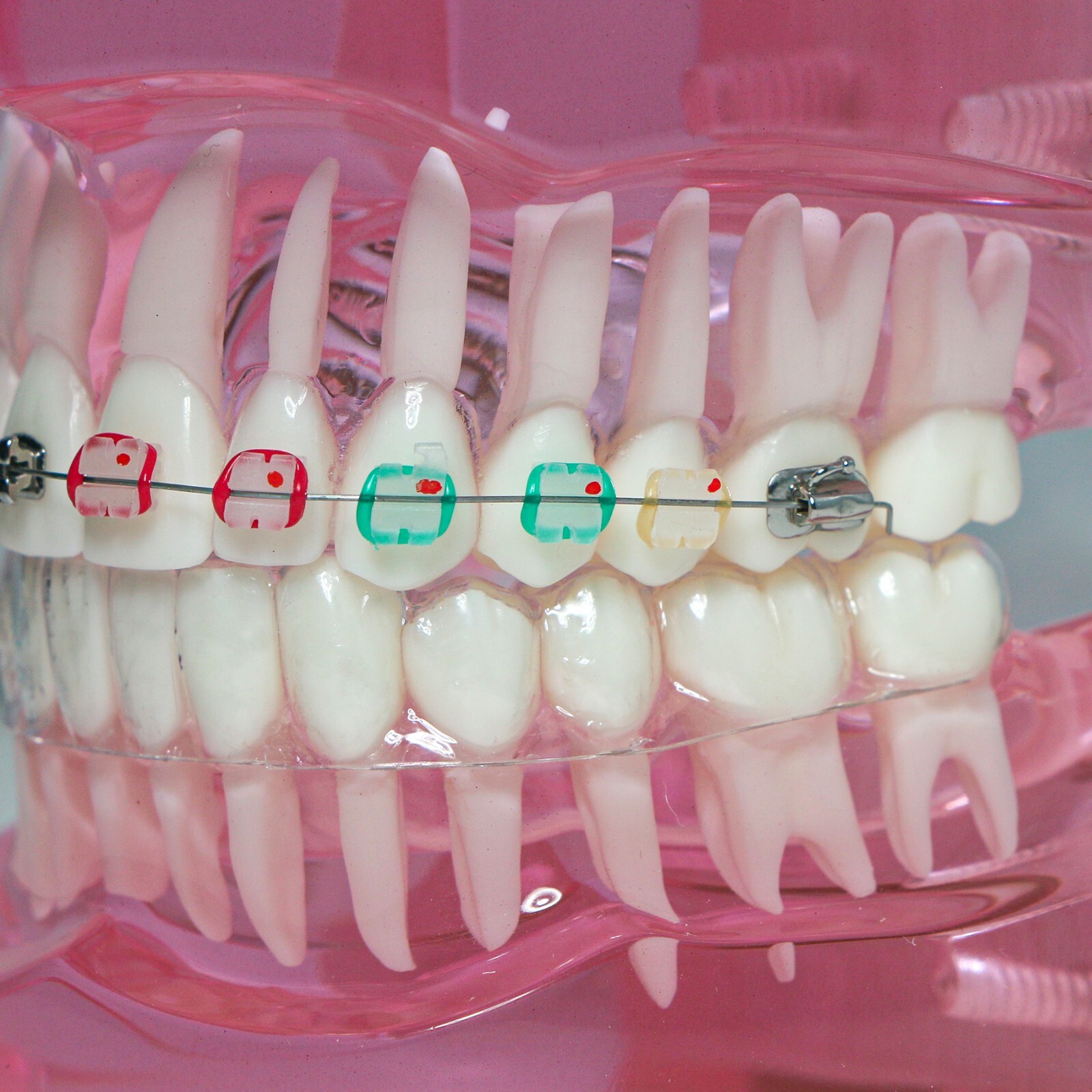Dental Ortho Teeth Model With Metal Ceramic Brackets Lingual Braces Tube Teach