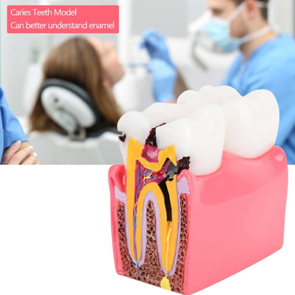 Caries Comparison Study Models Dentist Dental Anatomy Education Teeth Model