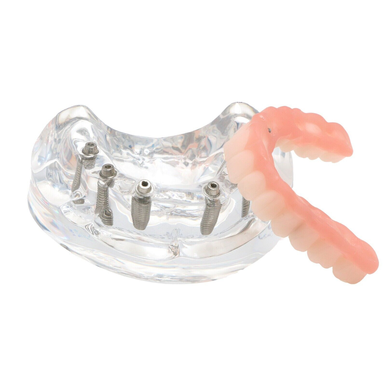 Dental All-On-6 Overdenture Implant Model Demo Upper Jaw 6 Screws Clear M6001-2