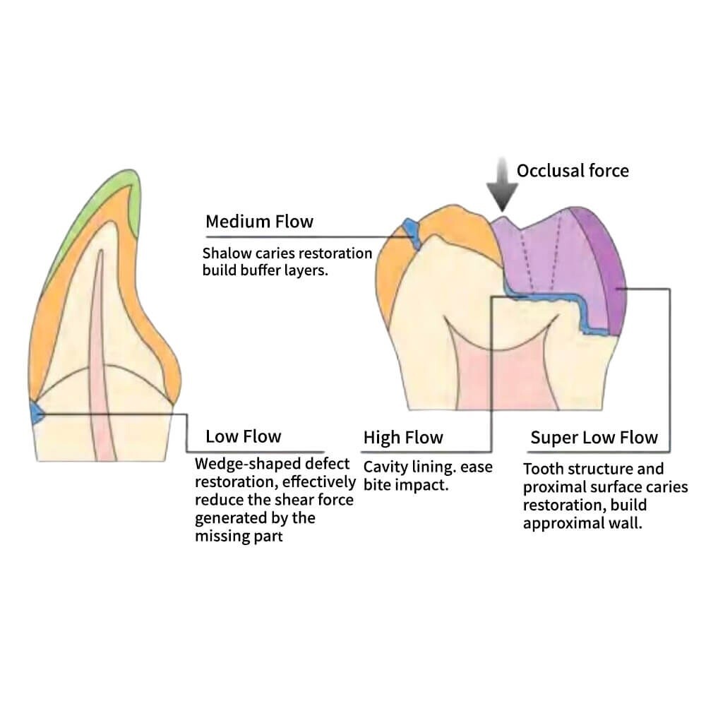A3.5 Flowable Composite, 3g Syringe, Medium Flow, 4 Shades, Light Cure