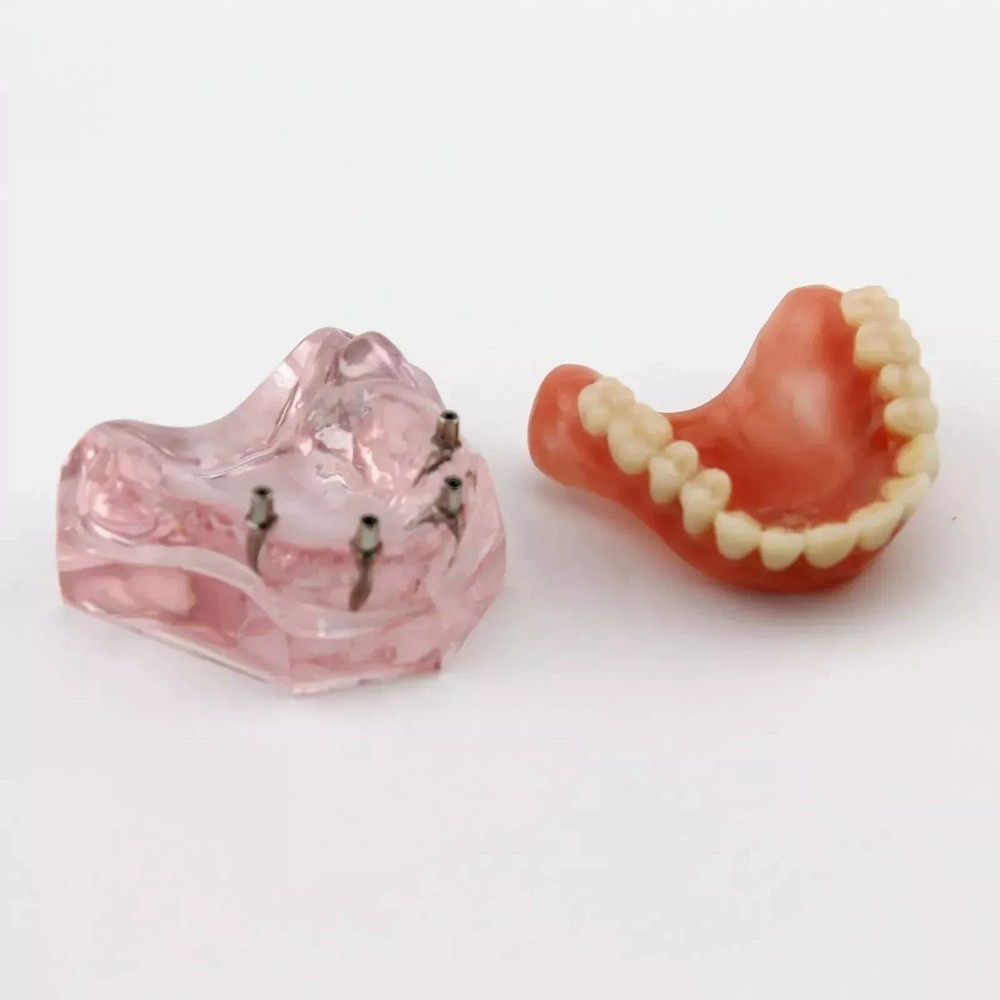 7 Types Dental Overdenture Restoration Model Implants Typodont Teaching Study