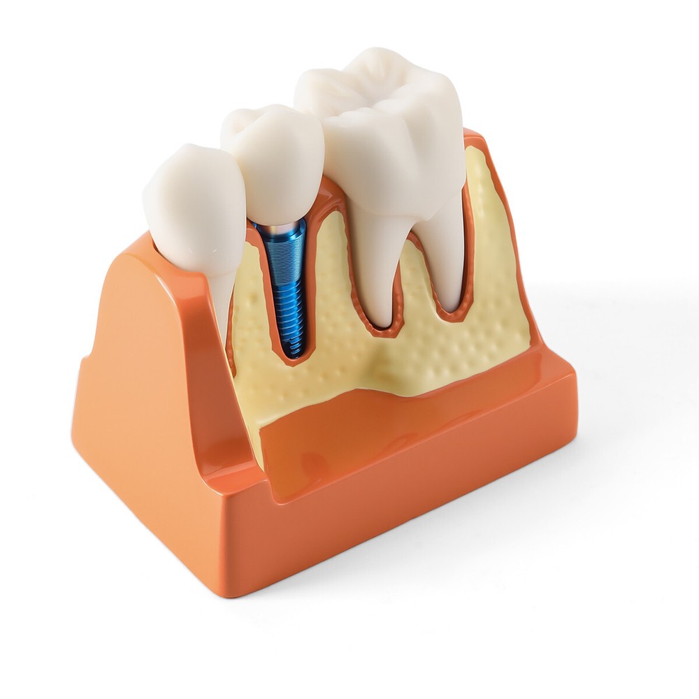Dental 4Times Teeth Model Implant Analysis Crown Bridge Removable Study Training
