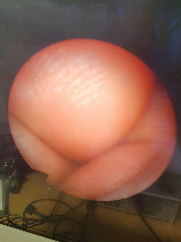 Olympus Arthroscope A7506A w Sheath & Light Cable