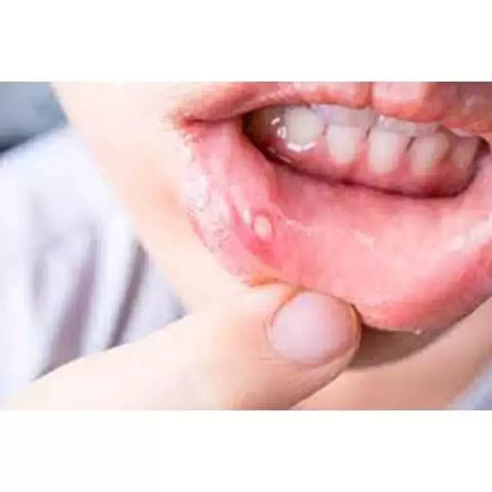 Clotrin Mouth Paint (1%w/v) (15ml)