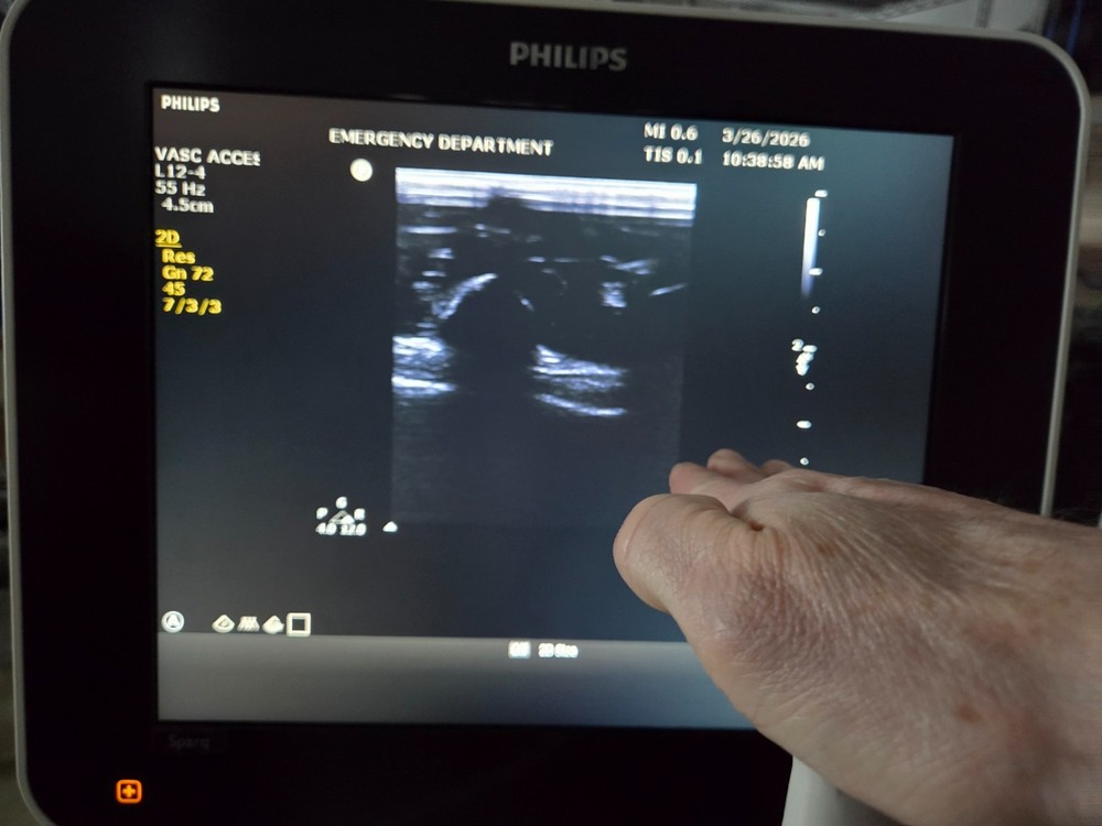 Philips L12-4 Linear Array Probe Ultrasound Transducer - Working - Cord Damage