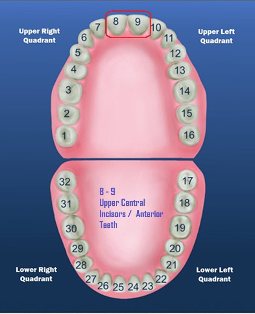 DENTAL POLYCARBONATE TEMPORARY CROWNS #15 (ULC) UPPER LEFT CENTRAL 5/PACK