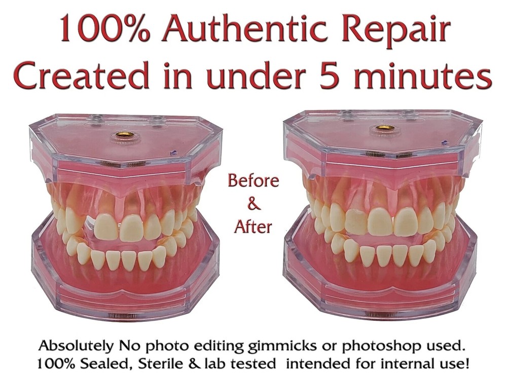 SmileFix Basic Dental Repair Kit - Missing or Broken Tooth. Gaps Broken Teeth...