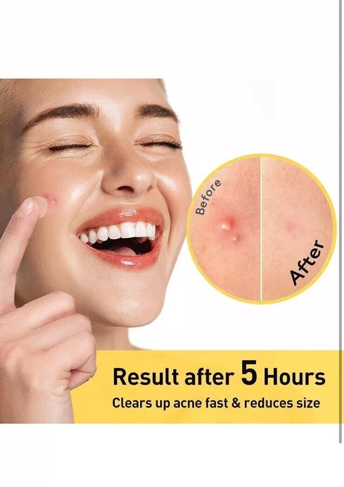Silky Sense Beveled Acne Patches