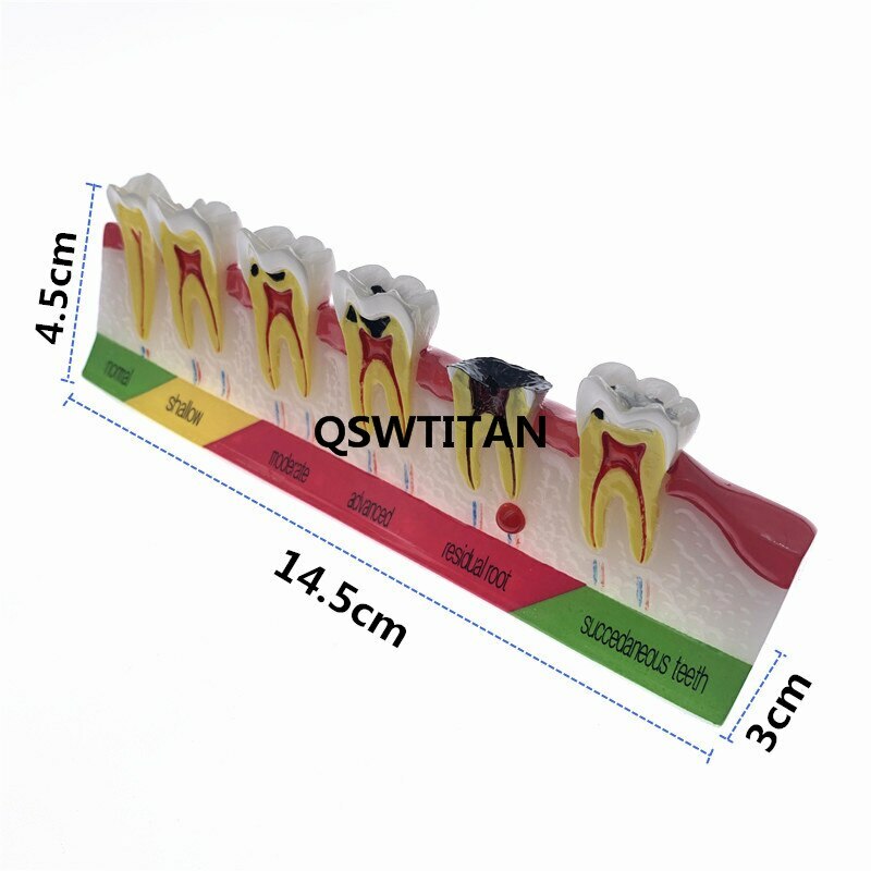 Dental Caries Classify/Evolution model Tooth Model Dental Study Model