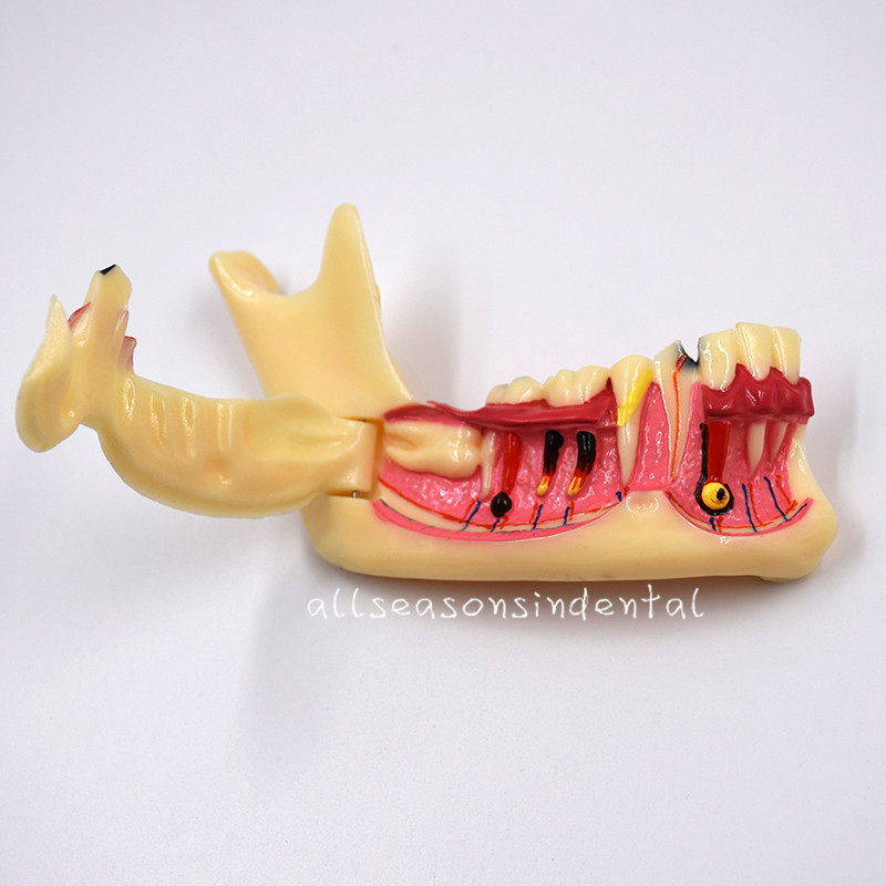 1 Pcs Dental Mandibular Tissue Teeth Anatomical Model Patient Teach Study Model