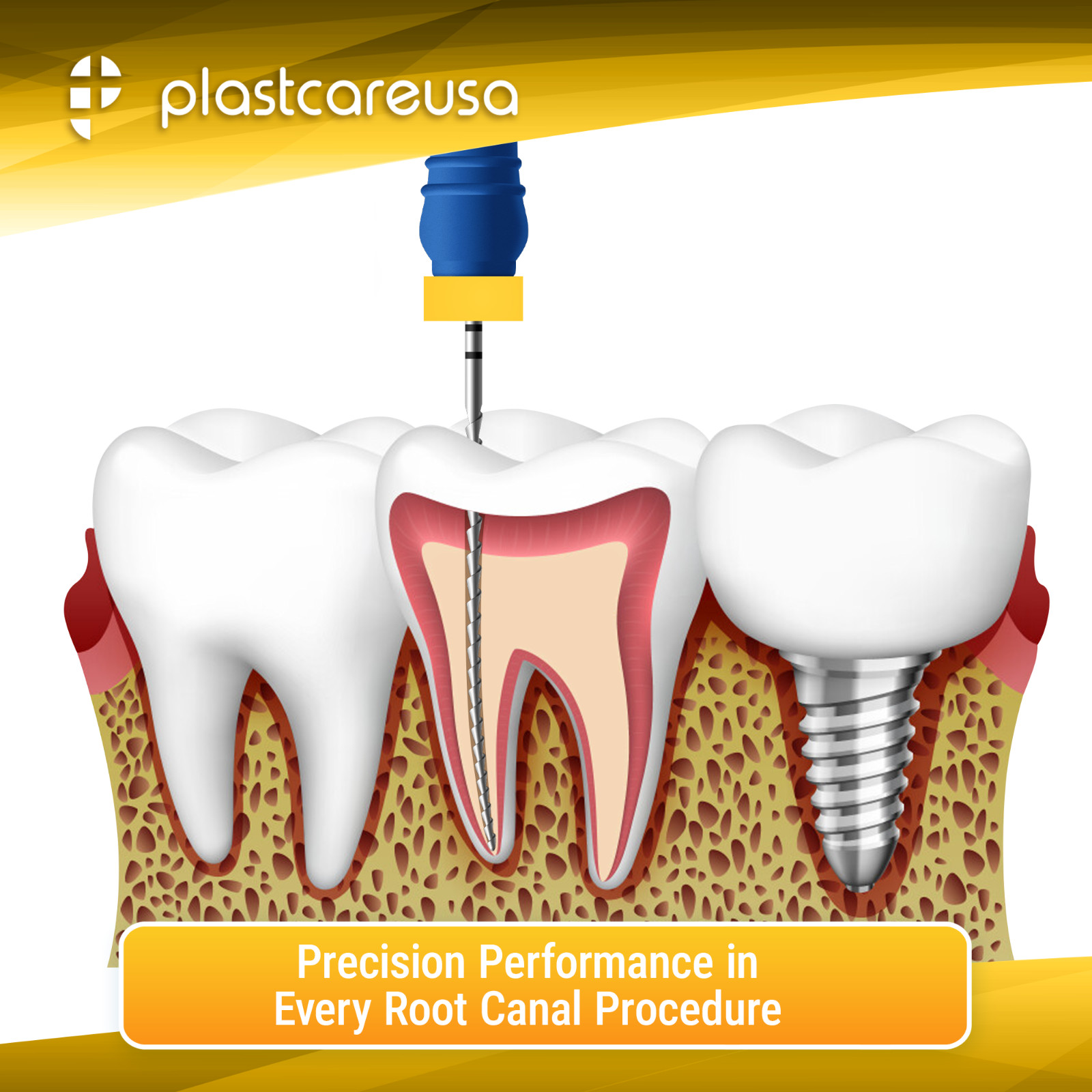 25mm Endodontic H Files H File Hedstrom Stainless Steel, Endo Dental Rotary
