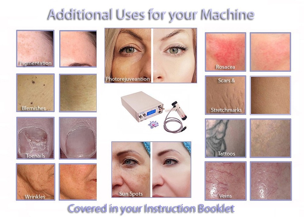 Professional Laser Diode Hyperpigmentation System with Treatment Gel Kit.