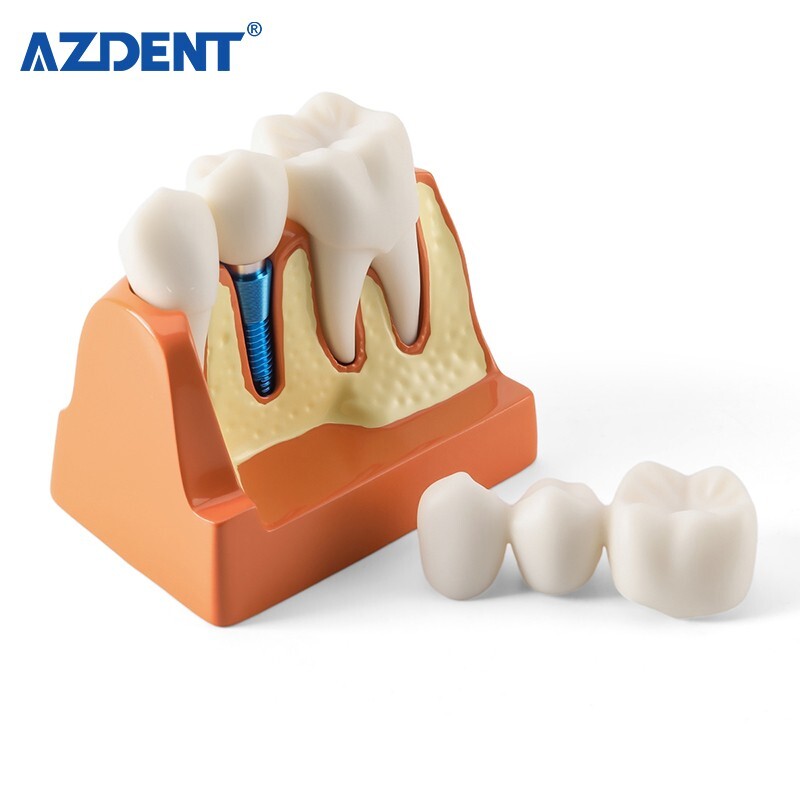 4 Times Dental Teeth Removable Model Implant Teaching Learning Tool Analysis