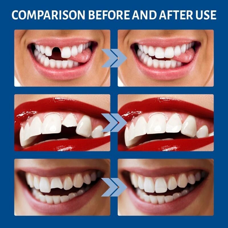 Temporary Tooth Repair Kit Temp Dental Repair Replace Missing Teeth DIY Moldable