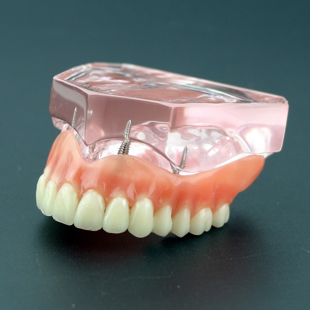 Dental Implant Overdenture Upper Superior Model Precision 4 Maxillary