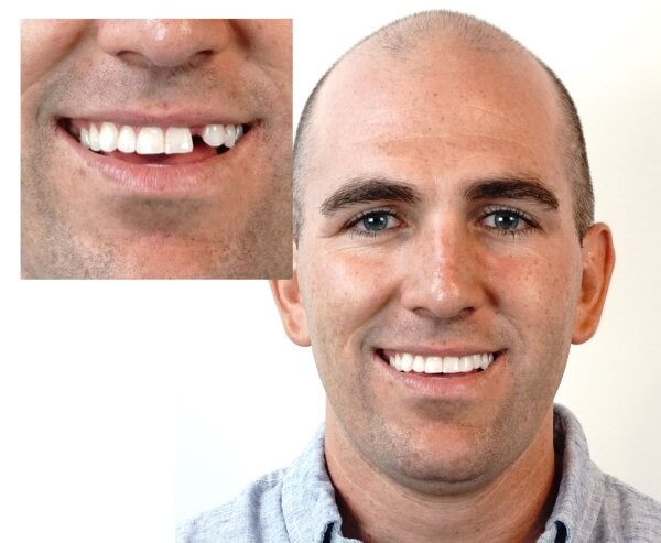 Instant Smile Complete Your Smile Tooth Replacement Kit fix missing teeth