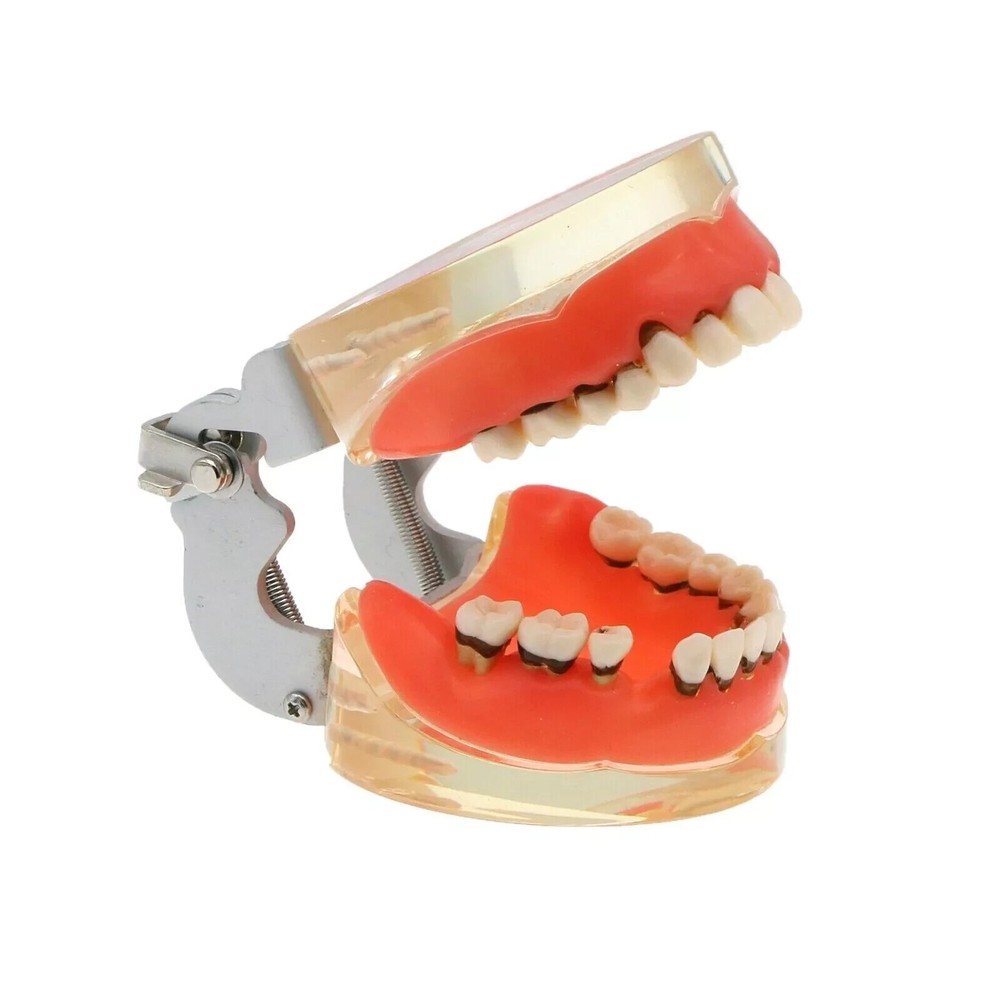 Dental Teeth Model Pathological Disease M4017 Removable Teaching Study Model