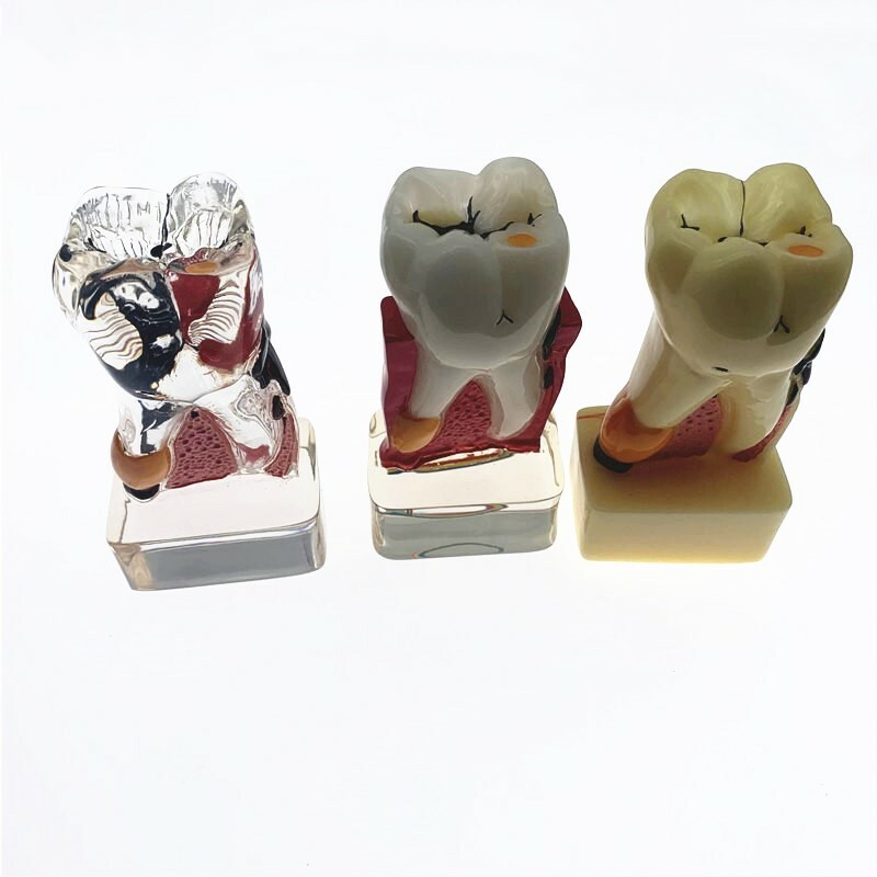 Teeth Model 4 times tooth pathology Comprehensive Periodontal teaching models