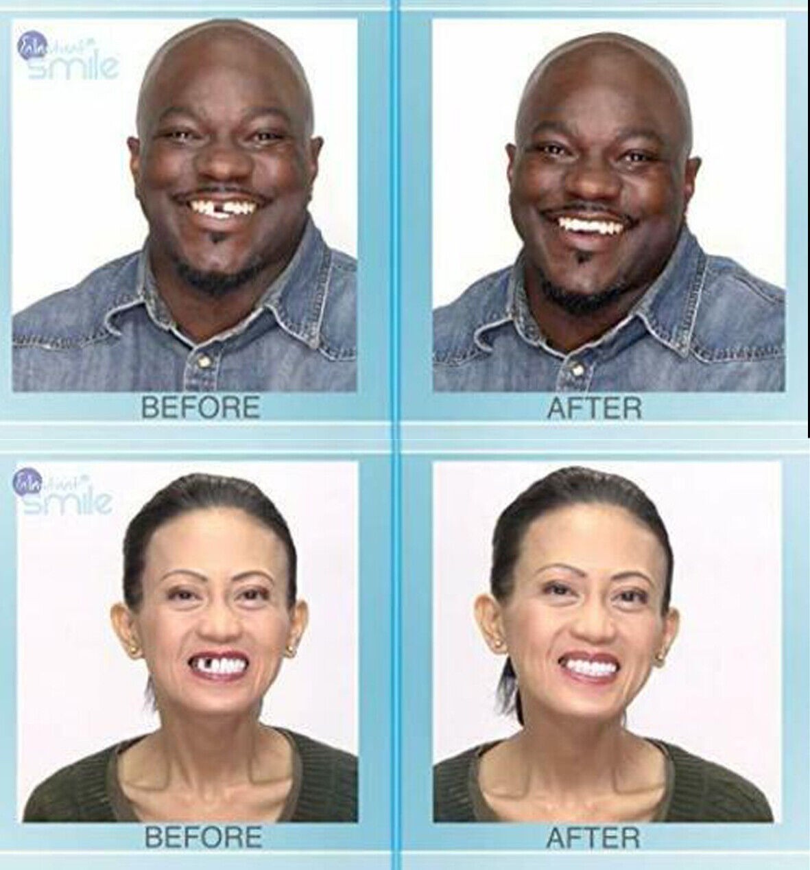 Instant Smile Multi-Shade Temporary Tooth Repair Kit 3 SHADES-Rapid Repair