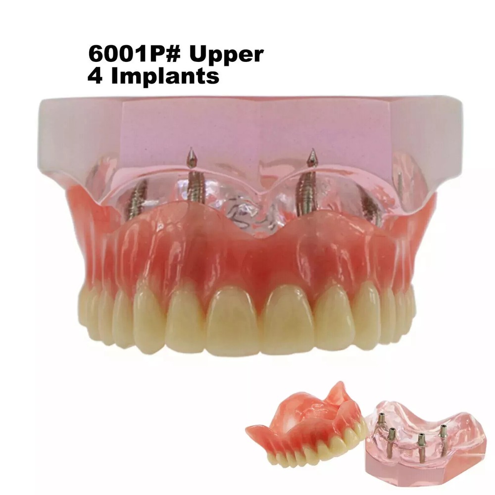 Dental Restoration Teeth Typodont Implants Model Demonstrate Overdenture 3 Model