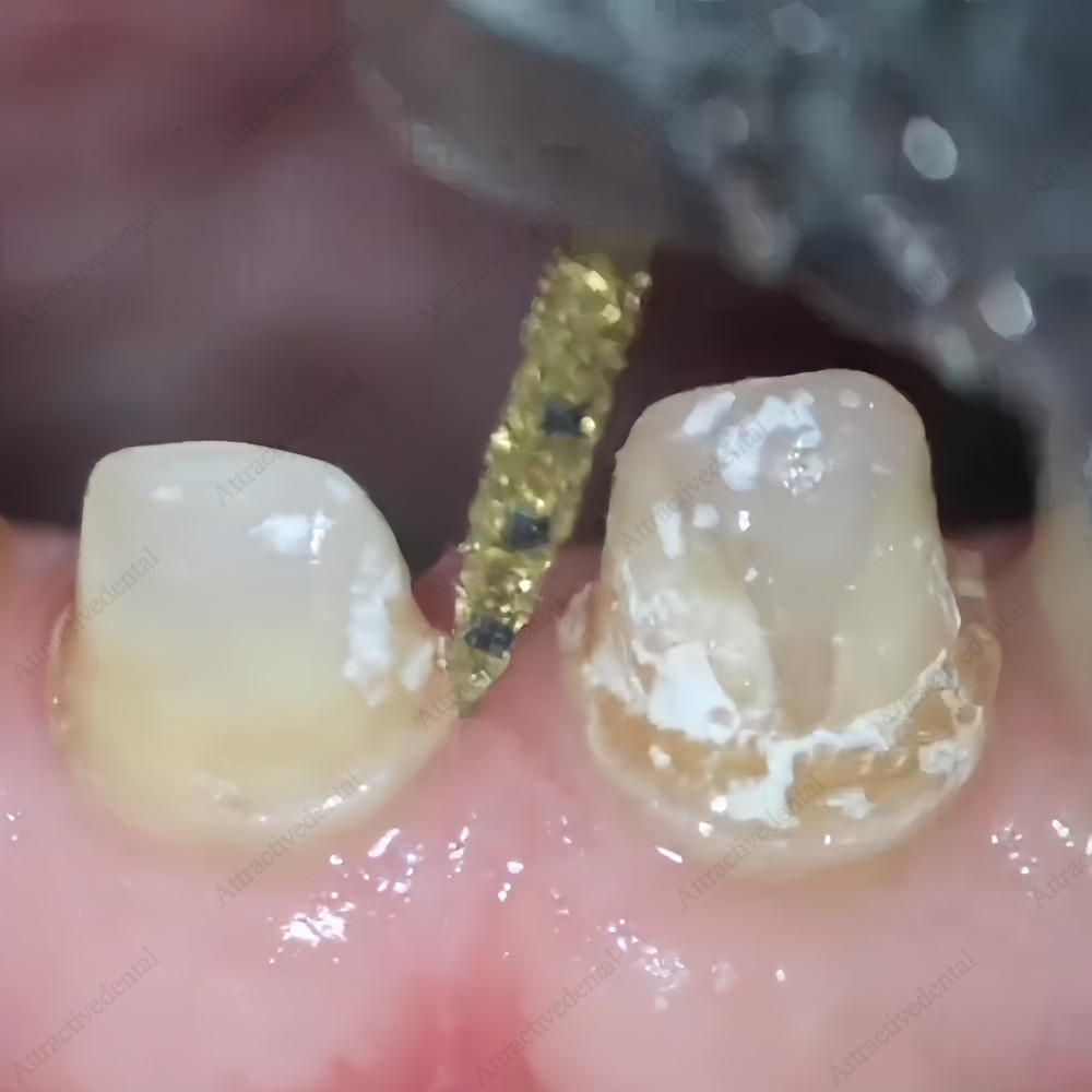BOPT Dental Vertical Diamond Bur Biologically Oriented Preperation Technique USA
