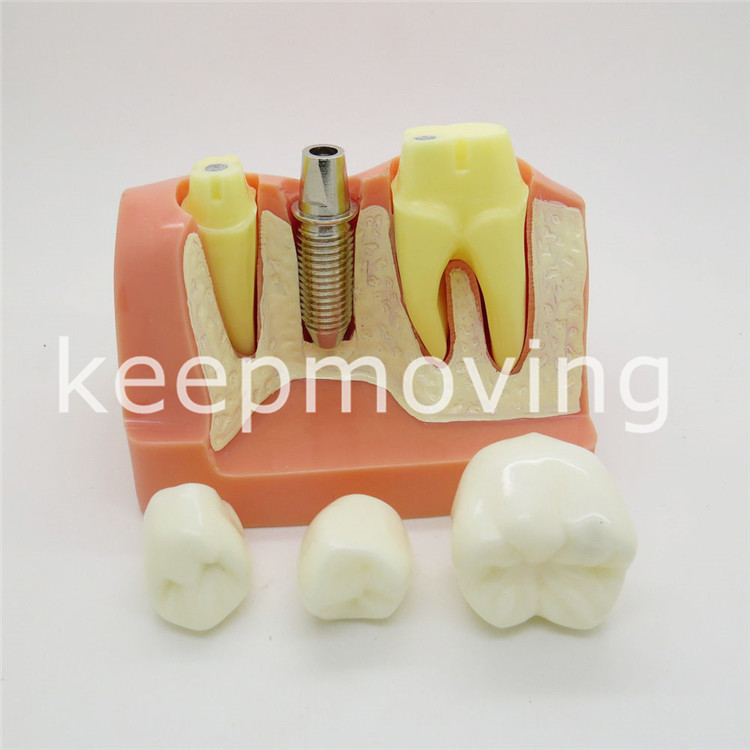 Dental Implant Teeth Model Analysis Crown Bridge Demonstration Teeth Model 2017