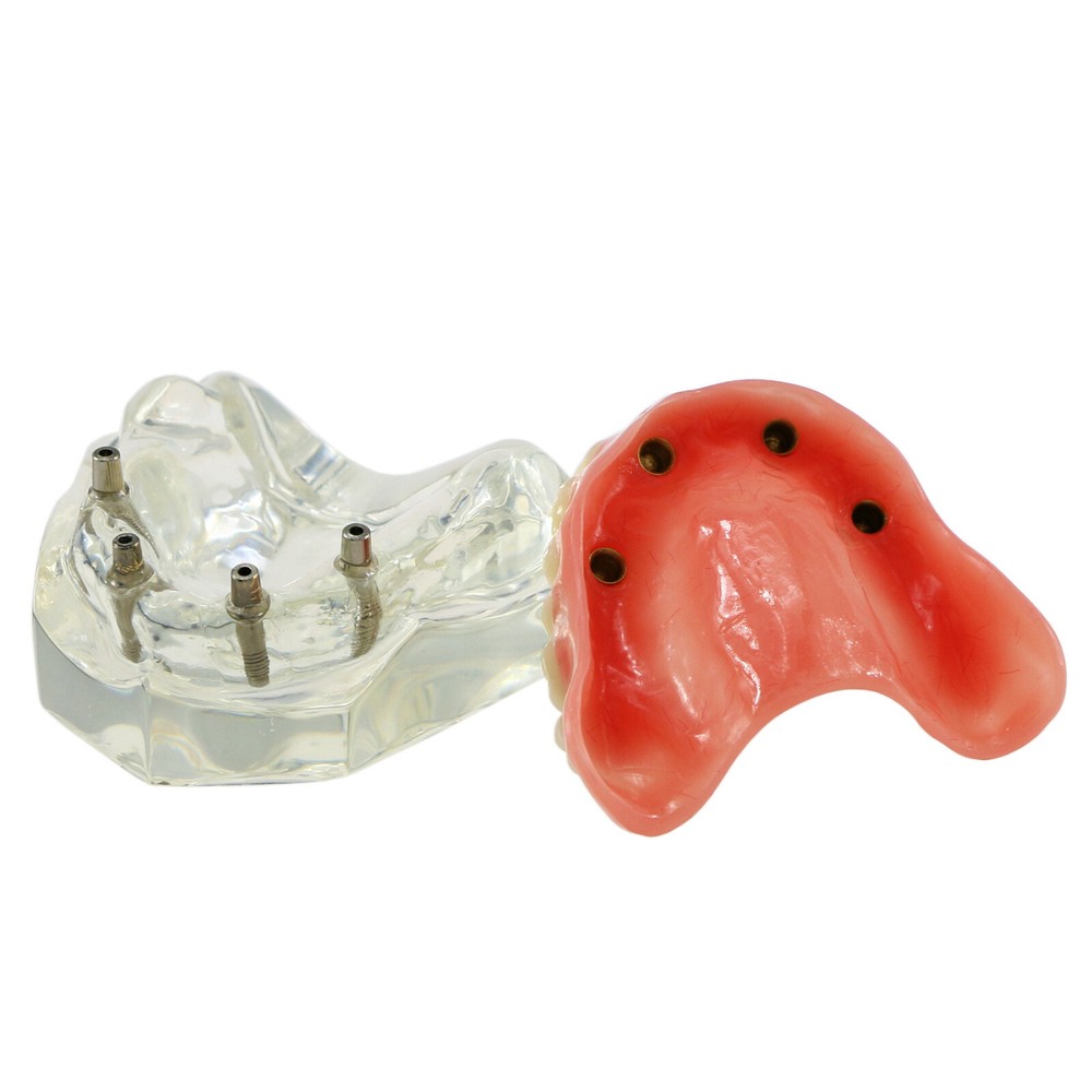 Dental Typodont Teeth Model 4 Implants Upper Overdenture Superior M6001 Clear