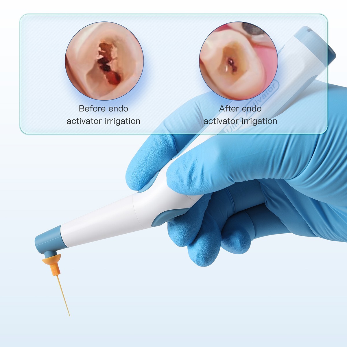 AZDENT Dental Endo Ultrasonic Sonic Activator Root Canal Irrigator+60 Tips