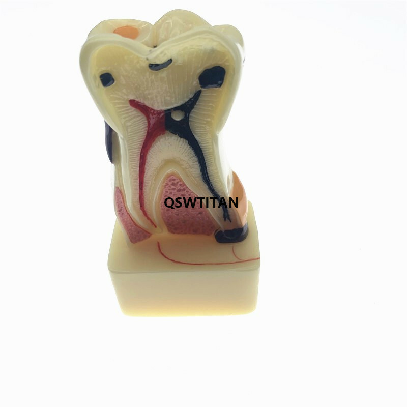 Teeth Model 4 times tooth pathology model Periodontal Teaching Study model