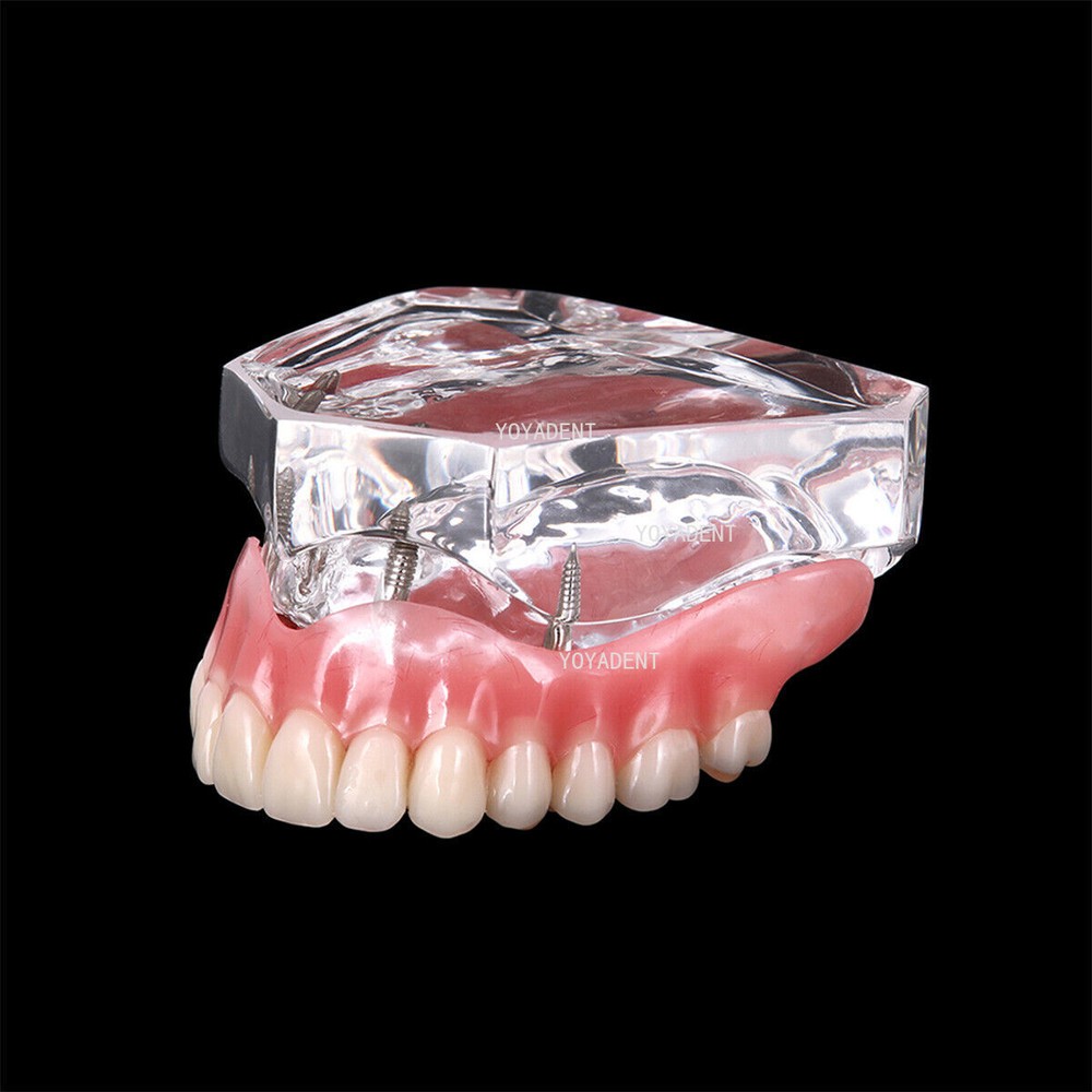 Dental Model 4 Implants superior/Mandibular Removable Overdenture Teeth Model
