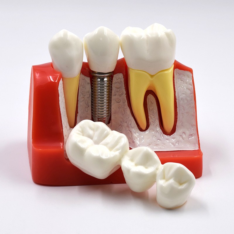 Dental Implant Analysis Crown Bridge Demonstration Teeth Study Model Typodont