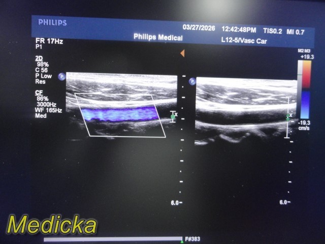 Philips L12-5 Linear Array Ultrasound Transducer *TESTED & WORKING* ~ 39679