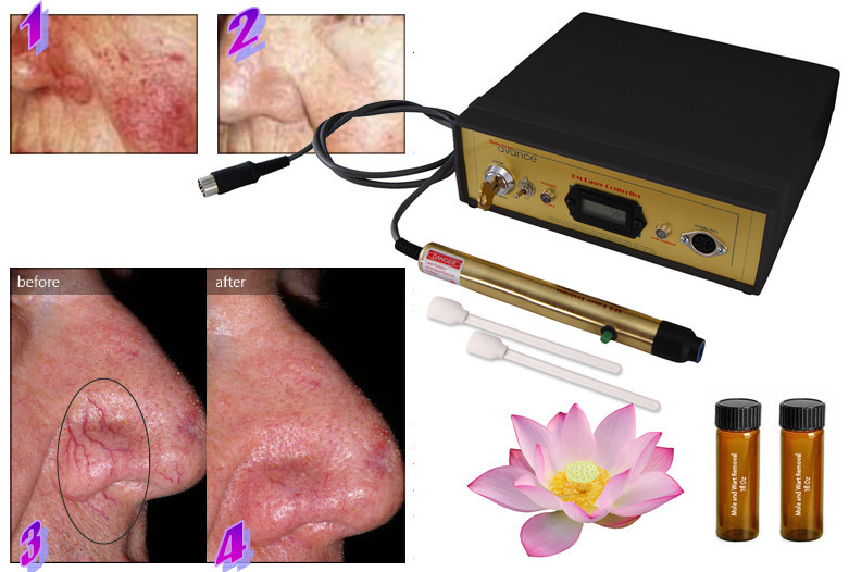 Avanced laser spider varicose vein reduction Machine, Permanent Results *