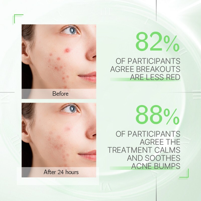 Severe Acne Pimple Treatment Serum Cystic Spot Remover Reduce Redness Swelling