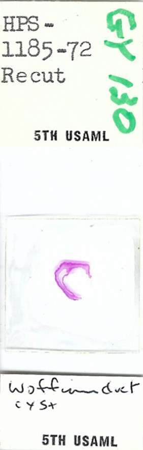 Human Wolffian Duct Cyst Pathology Microscope Slide