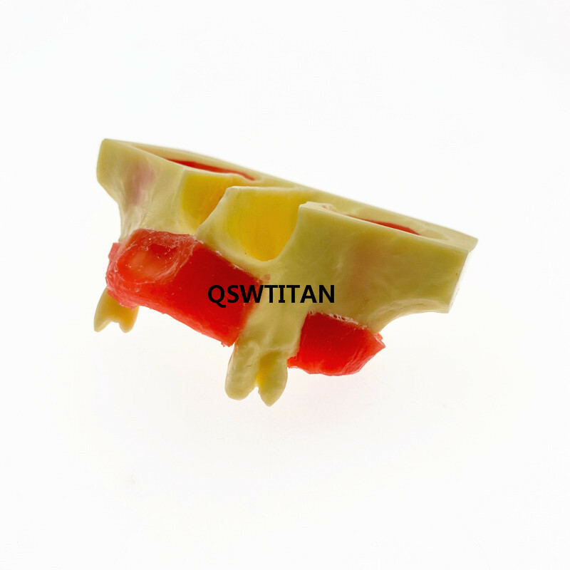 Dental Sinus Lift Practice Teeth Model Typodont Study Tooth Model M2012