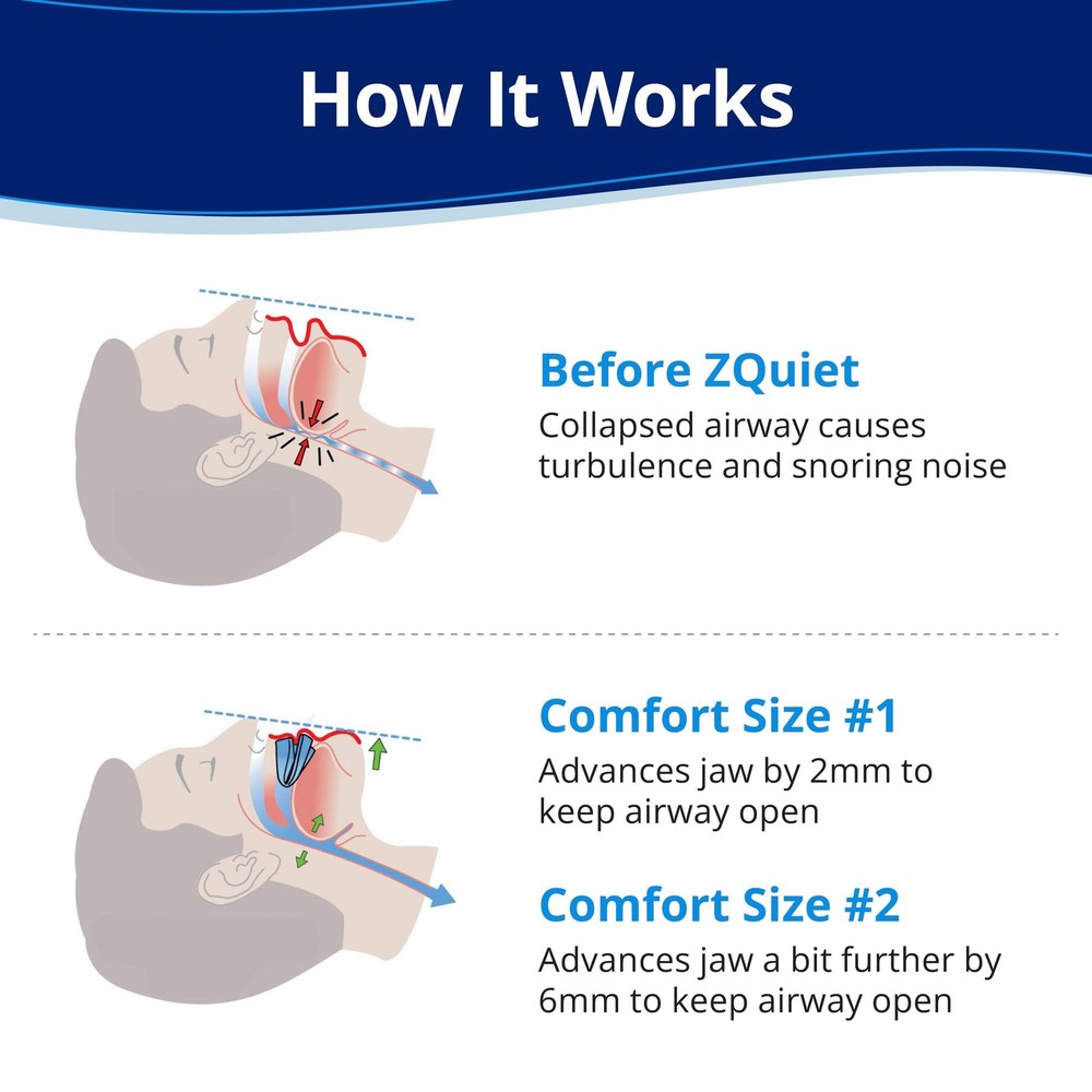 ZQuiet Anti-Snoring Mouthpiece Starter Pack| 2 Sizes | Open Front