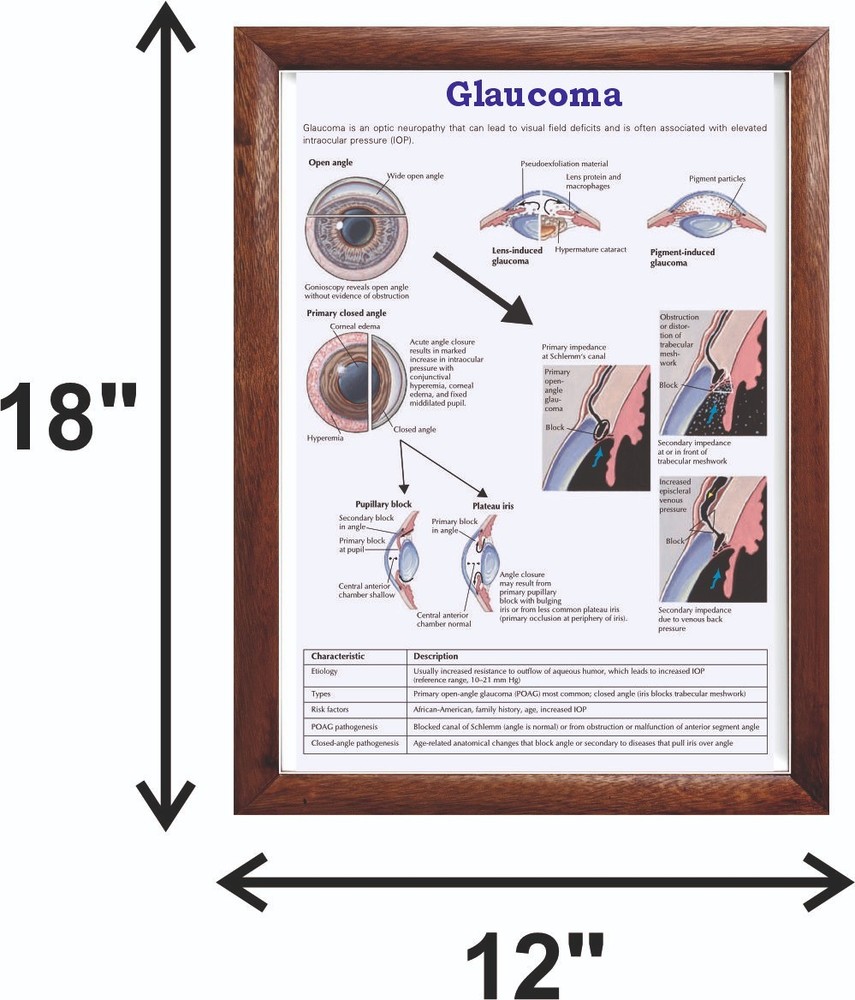 Glaucoma Chart 12x18 inches