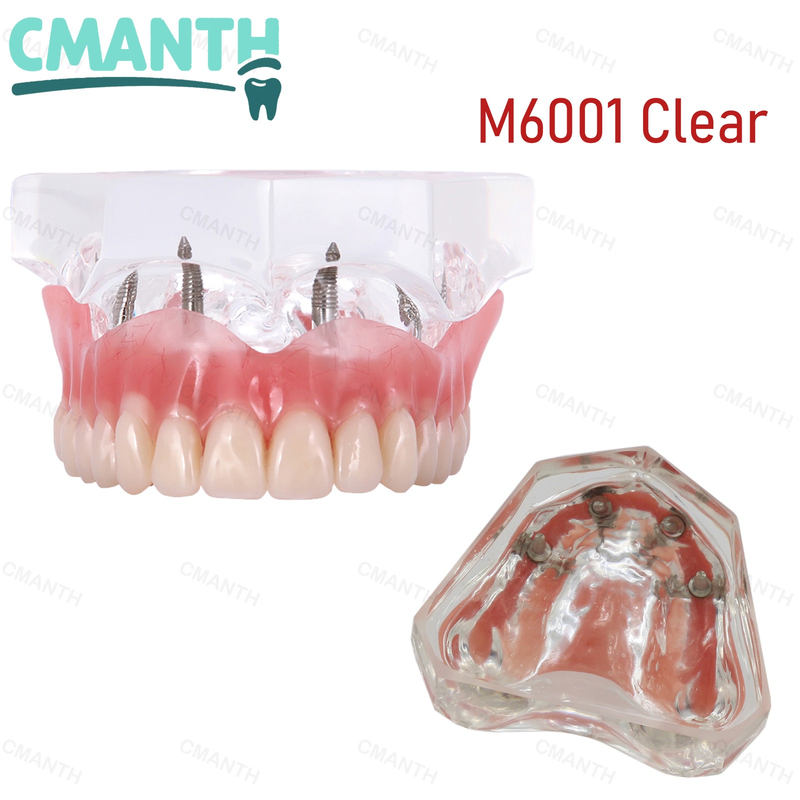 US Dental Removable Overdenture Teeth Model 4 lmplants Restoration Demo Clear