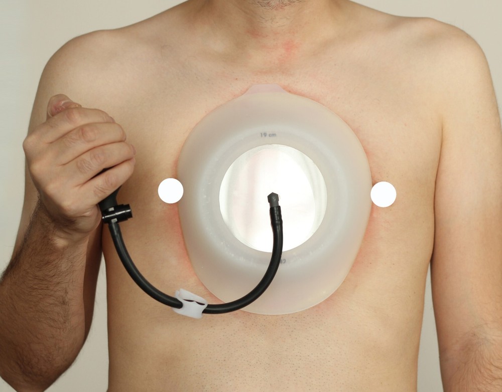 Vacuum Bell 16cm (M) Pectus Excavatum