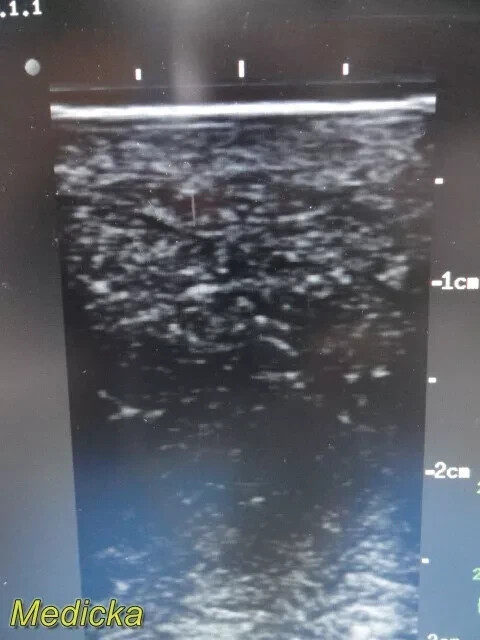 Chison Tech L-VA Linear Array Probe – Vascular Imaging for SR-6 (Tested) ~ 36100