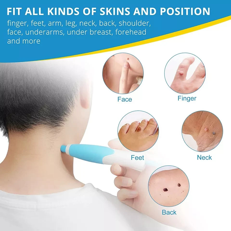 Auto Micro Skin Tag Remover Device Kit Safe Painless Removal 2-8 mm Band Tool