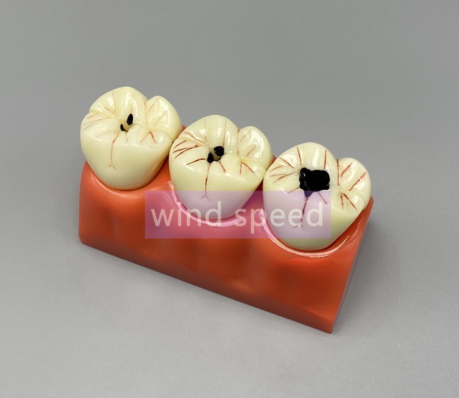 Dental Teaching Model 4 Times Caries Disassembling Comparations Implant Model