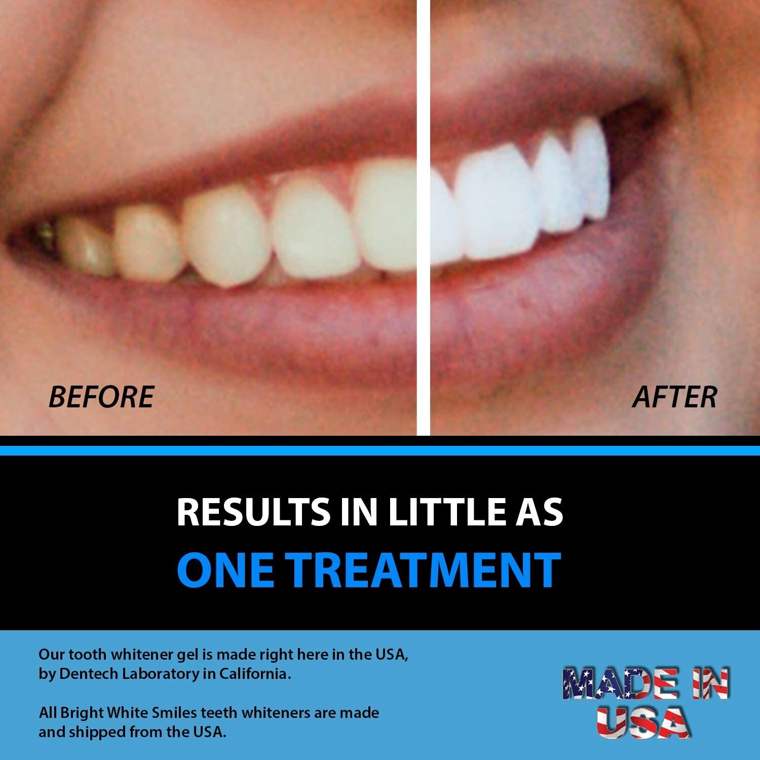 45% PEROXIDE GEL TEETH WHITENING TOOTH WHITENER BLEACH 10 SYRINGES DENTAL REFILL