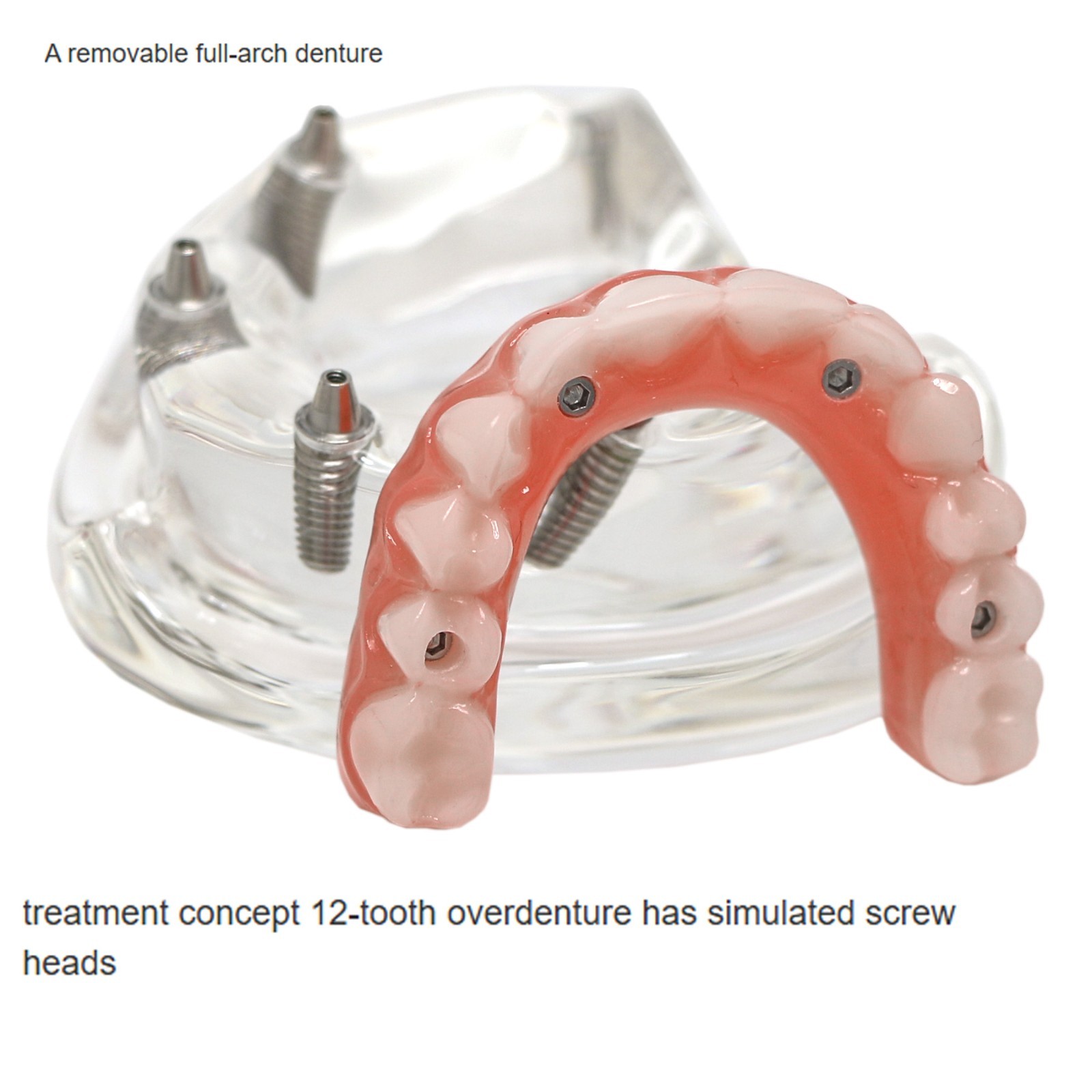 Implant Overdenture Al-on-4 treatment concept Demo Teeth Model Upper/4Srew Clear