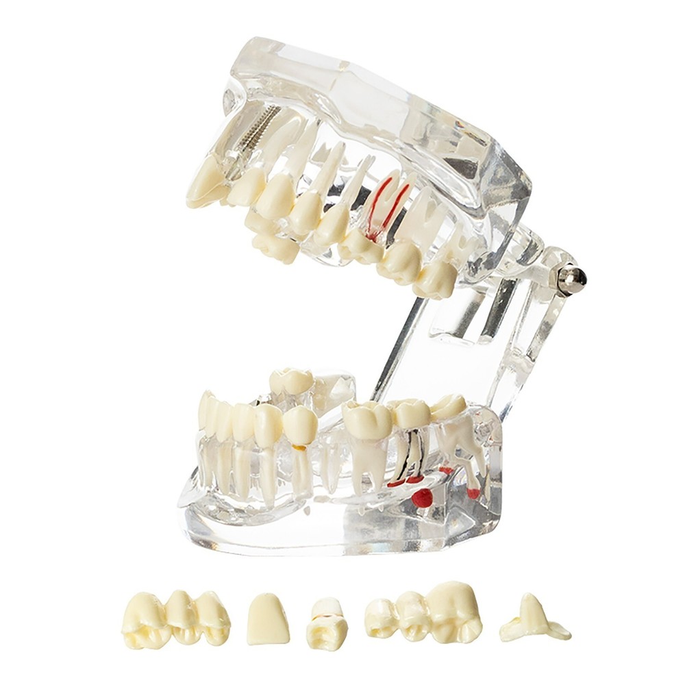 Dental Removable Restoration &Implant Pathological Disease Teeth Study Model