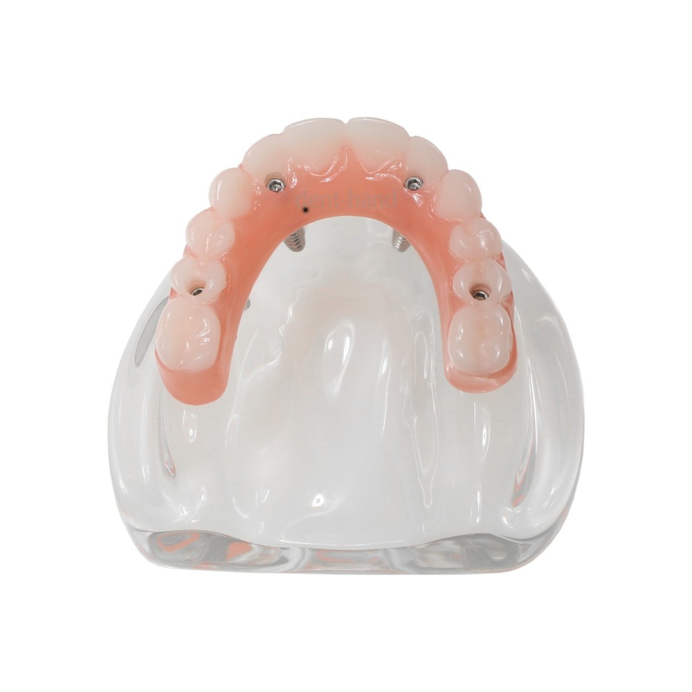US Dental Overdenture Upper/Lower 4 Implants Demo Teeth Restoration Model