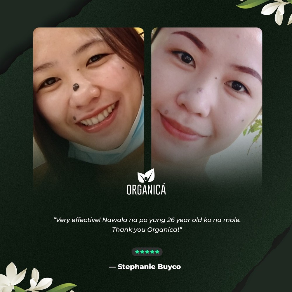 Multi-Awarded Mole and Warts Remover Set