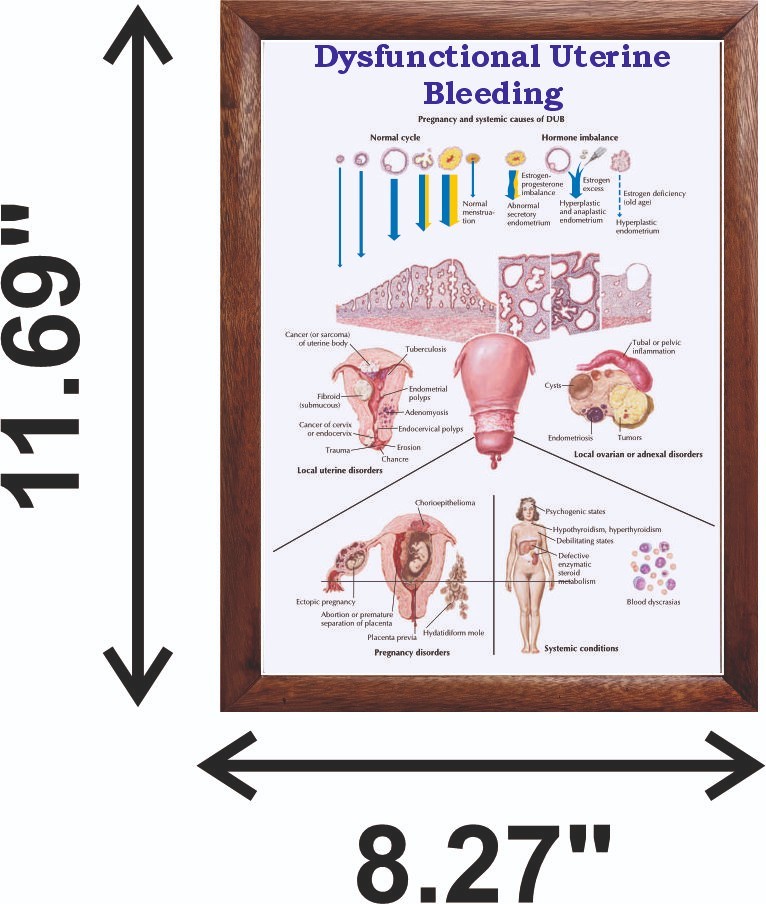 Dysfunctional Uterine Bleeding Chart 12x18 inches