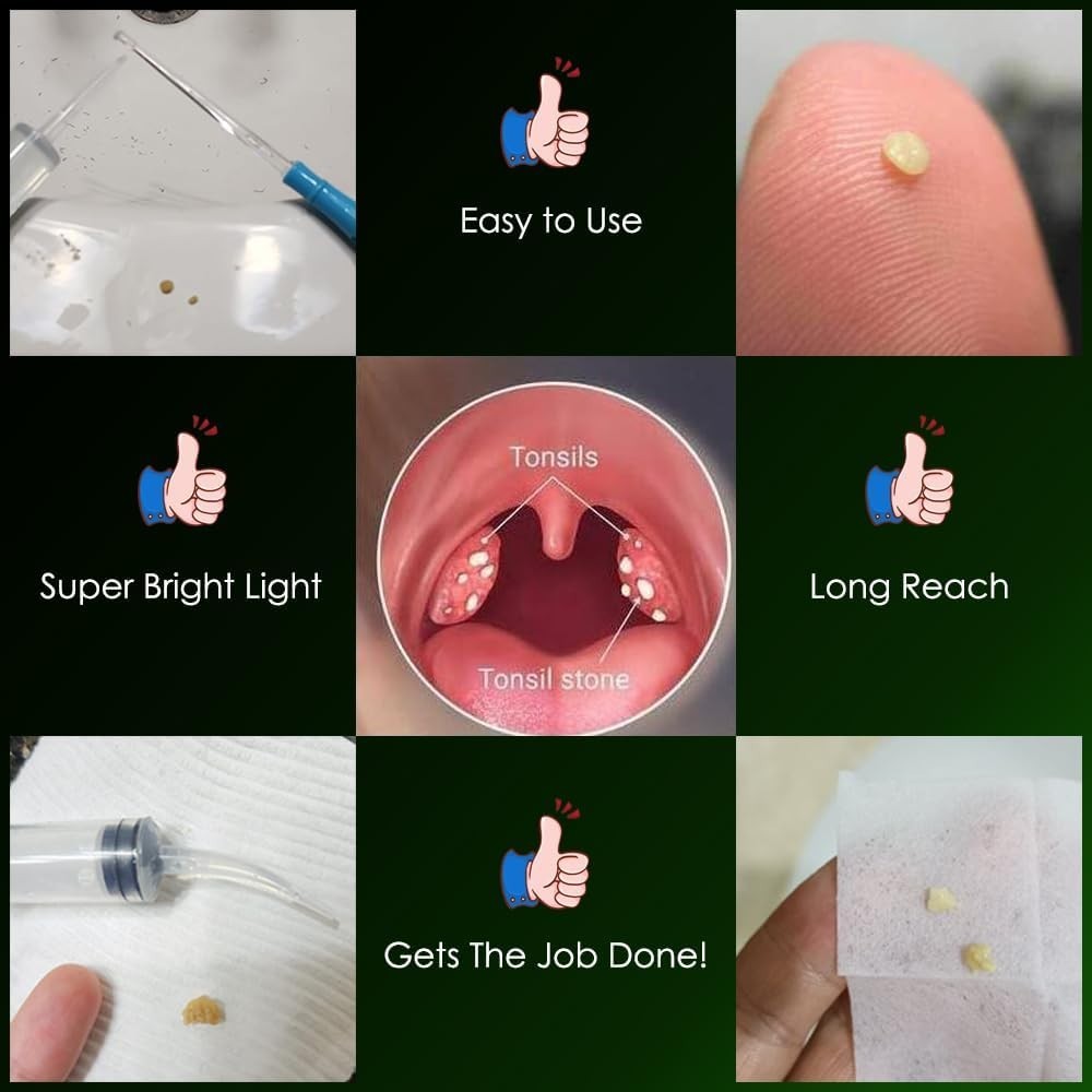 Upgraded Tonsil Stone Remover Tool, Blue, 5 Tips, Tonsillolith Pick Case + 1 ...